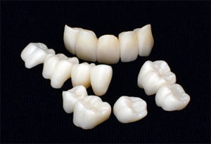 Vollkeramikkronen als Zahnersatz