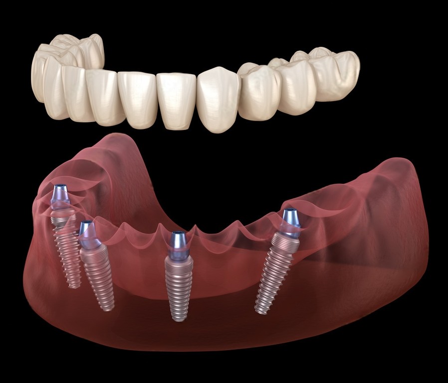 all-on-4 Dental Implants