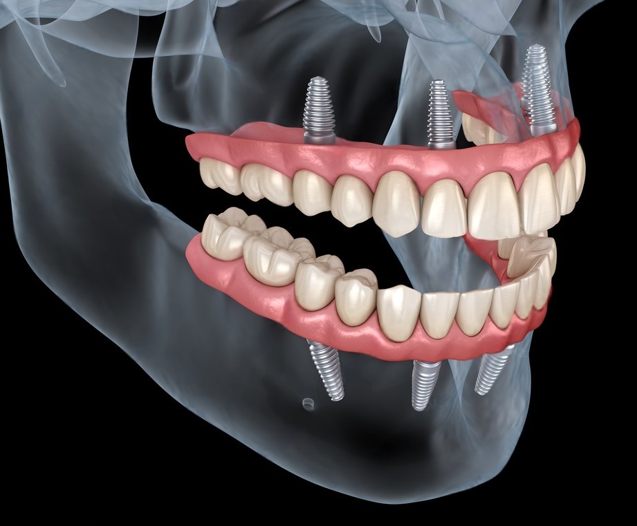 Zubní implantáty All-on-4