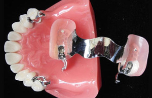 Geschiebeprothese als Zahnersatz