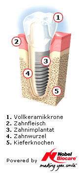 Zahnimplantat - Grafik: nobelsmile.de