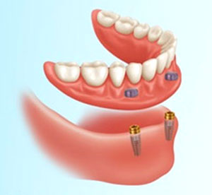 Zahnprothese oberkiefer ohne gaumenplatte