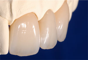 von natürlichen Zähnen kaum zu unterscheiden: ISP-e.max-Vollkeramik