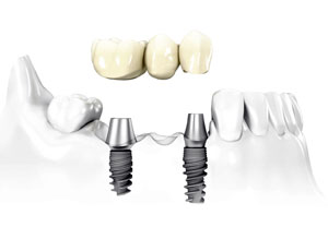 Zahnbrücke auf zwei Implantaten