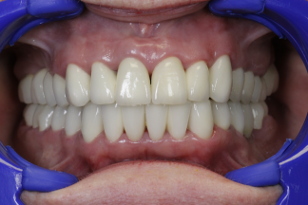 zirconium upper and lower after