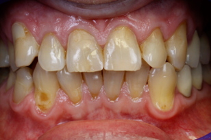 porcelain fused to metal upper and lower full round bridge before